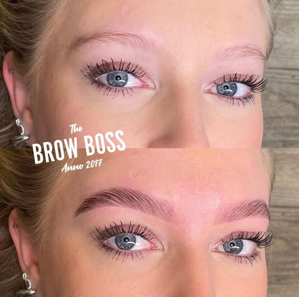 Brow lift